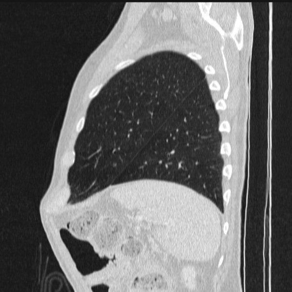 Azygos lobe (Radiopaedia 38259-40275 lung window 83).jpg