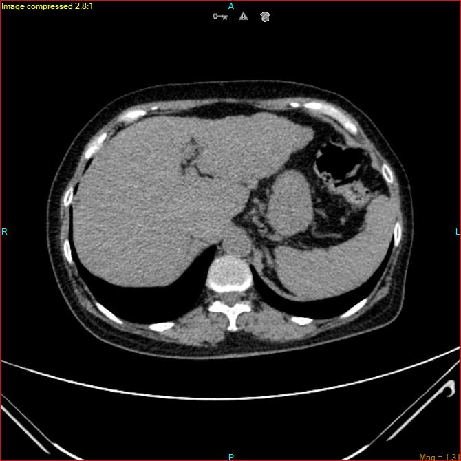 Azygos vein aneurysm (Radiopaedia 77824-90130 A 50).jpg