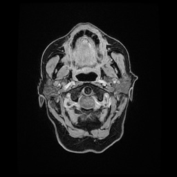 Balo concentric sclerosis (Radiopaedia 53875-59982 Axial LAVA C+ 11).jpg