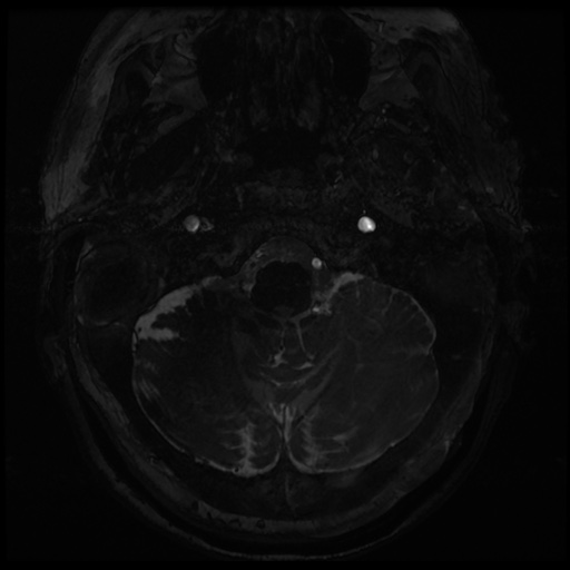 Balo concentric sclerosis (Radiopaedia 53875-59982 Axial T2 FIESTA 2).jpg