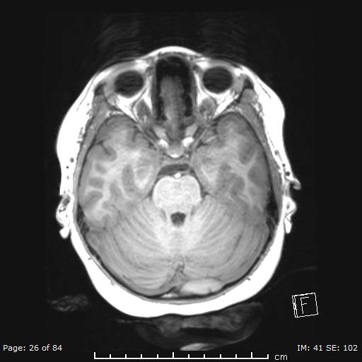 Balo concentric sclerosis (Radiopaedia 61637-69636 Axial T1 26).jpg