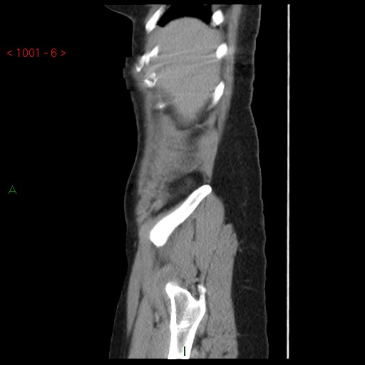 File:Bartholin gland cyst (Radiopaedia 54904-61181 Sagittal C+ delayed 6).jpg