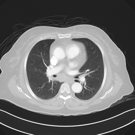 Basal ganglia metastasis (Radiopaedia 78928-91832 B 23).png