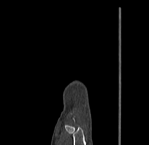 Base of 2nd metacarpal fracture (Radiopaedia 73741-84544 Sagittal bone window 25).jpg