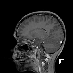 Base of skull rhabdomyosarcoma (Radiopaedia 32196-33142 J 39).jpg