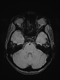 Basilar artery perforator aneurysm (Radiopaedia 82455-97733 Axial SWI 15).jpg