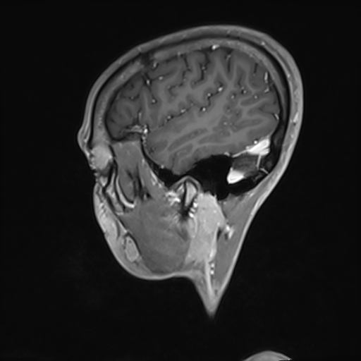 Basilar artery perforator aneurysm (Radiopaedia 82455-97733 G 28).jpg