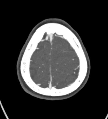 File:Basilar tip aneurysm with coiling (Radiopaedia 53912-60086 A 132).jpg