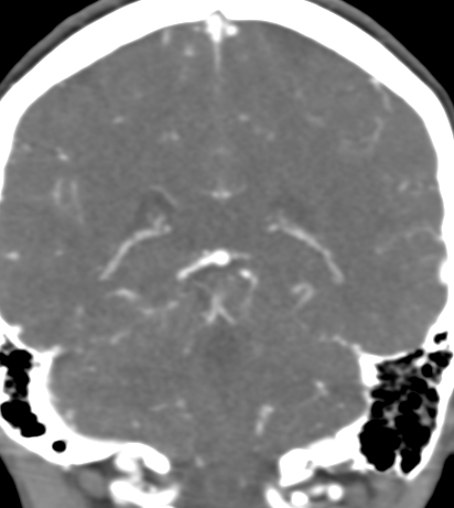 Basilar tip aneurysm with coiling (Radiopaedia 53912-60086 B 104).jpg