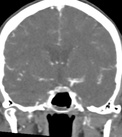 File:Basilar tip aneurysm with coiling (Radiopaedia 53912-60086 B 67).jpg