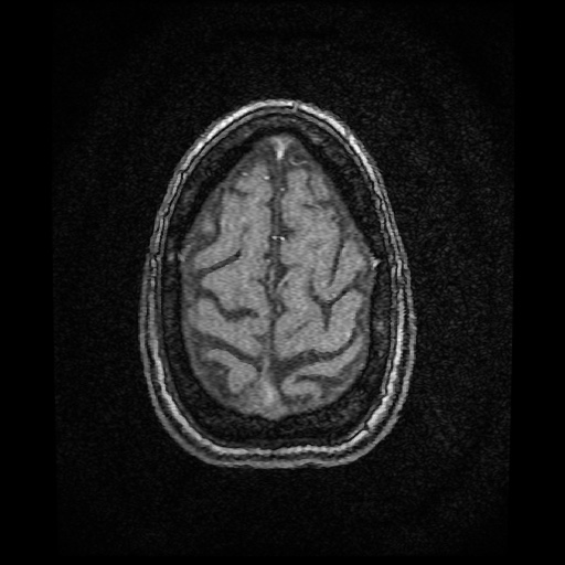 Basilar top and left middle cerebral artery aneurysm (Radiopaedia 61965-70031 Axial MRA 157).jpg