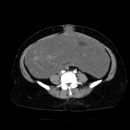 Benign spindle cell tumor - abdominopelvic (Radiopaedia 61300-69212 A 40).jpg