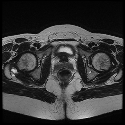 File:Bicornuate uterus (Radiopaedia 51676-57472 Axial T2 11).jpg