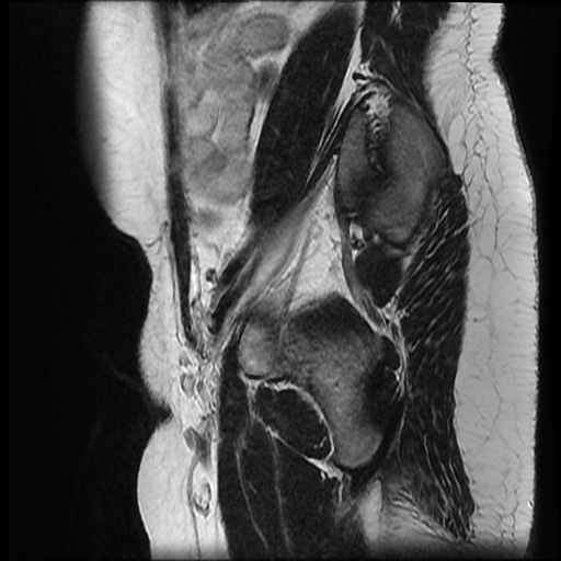 File:Bicornuate uterus (Radiopaedia 51676-57472 Sagittal T2 5).jpg