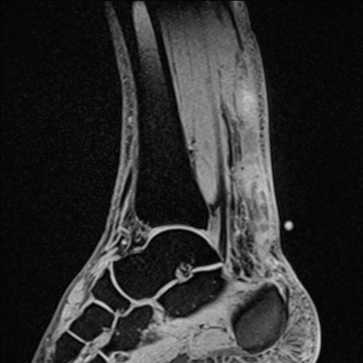 File:Bilateral Achilles tendon complete tear (Radiopaedia 81344-95051 Sagittal WE - Right 62).jpg