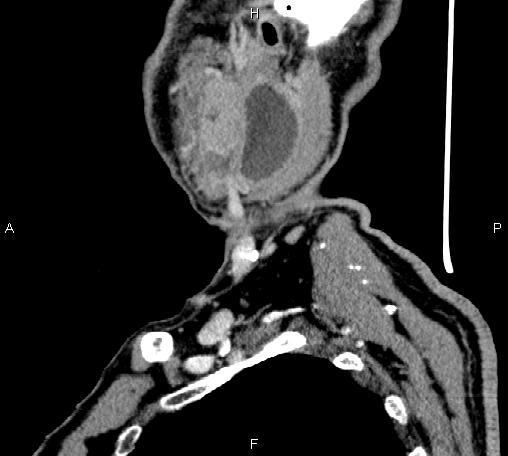 Bilateral Warthin tumors (Radiopaedia 84034-99263 D 20).jpg