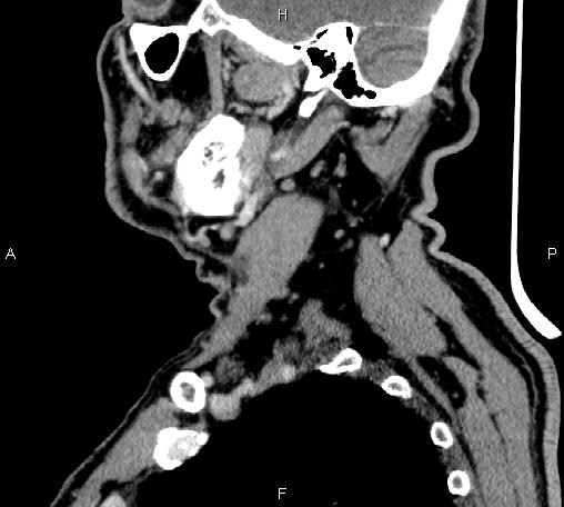 Bilateral Warthin tumors (Radiopaedia 84034-99263 D 57).jpg