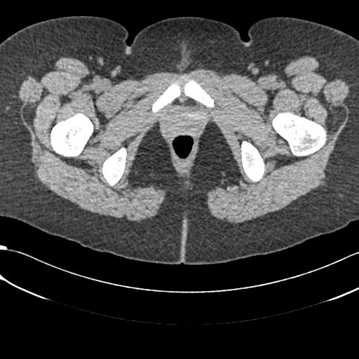 Bilateral acetabular protrusion with pincer type femoro-acetabular impingement (Radiopaedia 30134-30733 AXIAL SOFT THIN 82).jpg