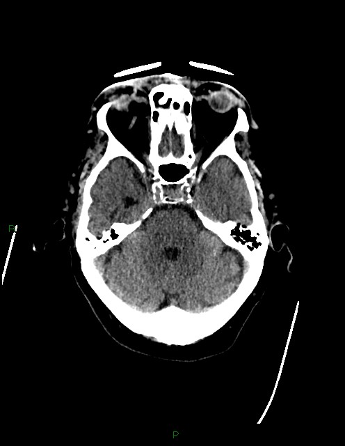 Bilateral acute middle cerebral artery territory infarcts (Radiopaedia 77319-89401 Axial non-contrast 25).jpg