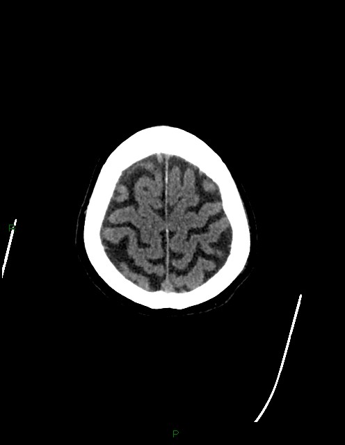 Bilateral acute middle cerebral artery territory infarcts (Radiopaedia 77319-89401 Axial non-contrast 80).jpg