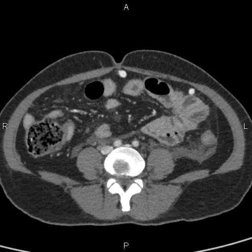 Bilateral adrenal gland hyperenhancement in pancreatitis (Radiopaedia 86642-102753 E 73).jpg