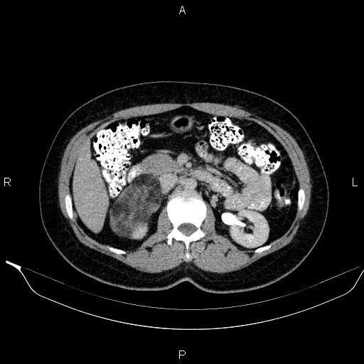 Bilateral adrenal myelolipoma (Radiopaedia 63058-71535 Axial C+ delayed 47).jpg