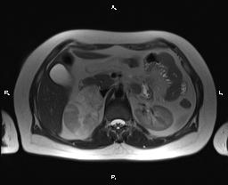 File:Bilateral adrenal myelolipoma (Radiopaedia 63058-71537 Axial T2 16).jpg
