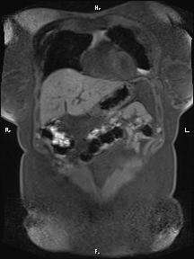 File:Bilateral adrenal myelolipoma (Radiopaedia 63058-71537 Coronal T1 fat sat 85).jpg