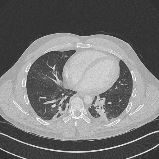 File:Bilateral atelectasis (Radiopaedia 48666-53675 Axial lung window 73).jpg