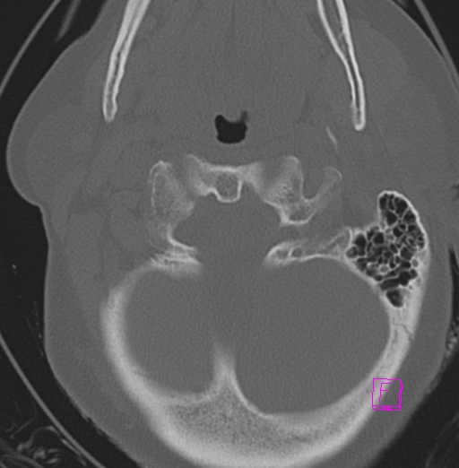 File:Bilateral atlanto-occipital assimilation (Radiopaedia 28350-28603 Axial bone window 9).jpg