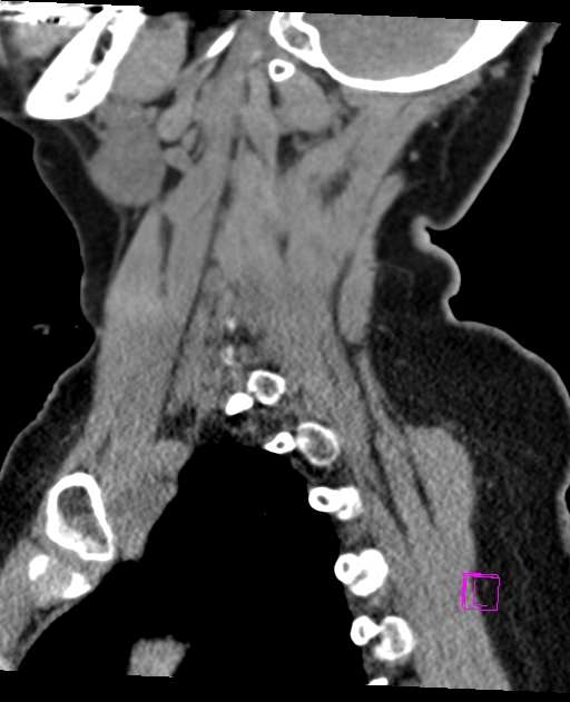 Bilateral atlanto-occipital assimilation (Radiopaedia 28350-28603 D 60).jpg