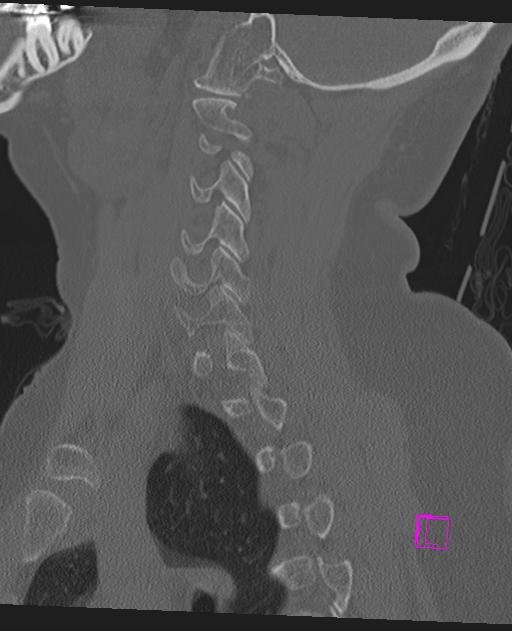 Bilateral atlanto-occipital assimilation (Radiopaedia 28350-28603 Sagittal bone window 54).jpg
