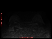File:Bilateral breast implant rupture (Radiopaedia 24761-25027 DWI 9).jpg