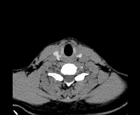 Bilateral carotid body tumors (Radiopaedia 61841-69870 Axial non-contrast 82).jpg