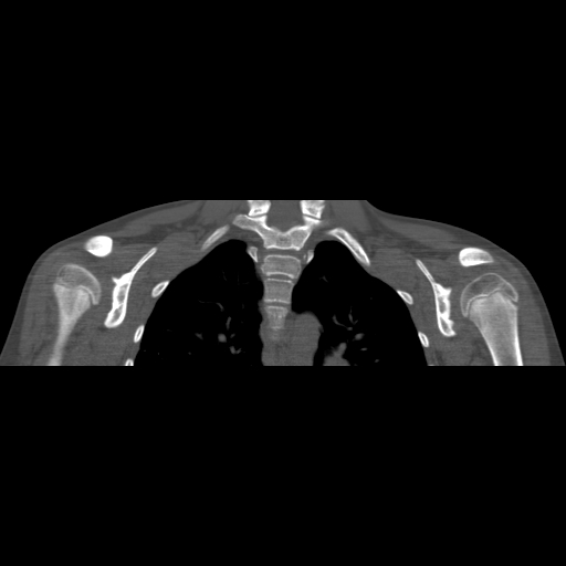 Bilateral chronic posterior shoulder dislocation (Radiopaedia 39213-41452 Coronal bone window 34).jpg