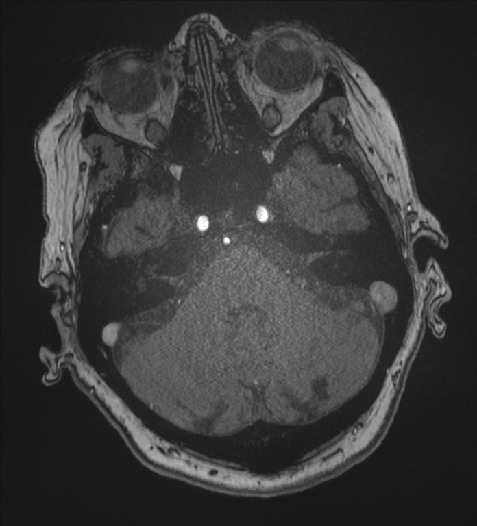Bilateral fetal posterior communicating arteries (Radiopaedia 41286-44102 Axial MRA 42).png