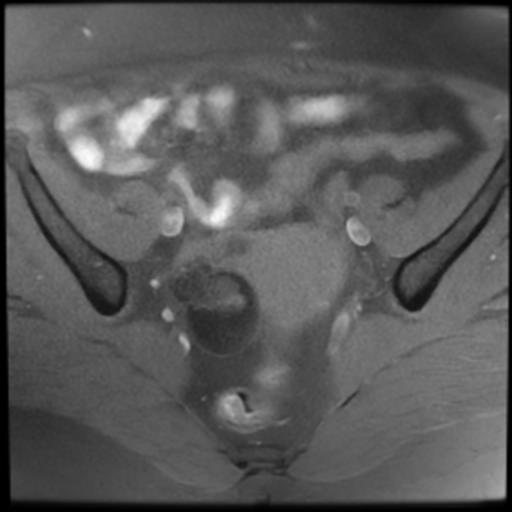 File:Bilateral ovarian dermoid cysts (Radiopaedia 90152-107338 Axial T1 fat sat 9).jpg