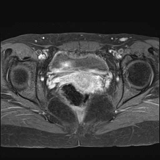 File:Bilateral ovarian endometriomas (Radiopaedia 87085-103347 Axial T1 C+ fat sat 15).jpg