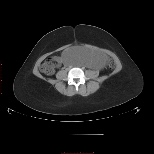 File:Bilateral ovarian serous cystadenocarcinoma with right ovarian torsion (Radiopaedia 32640-33611 A 27).jpg