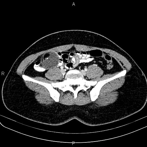 Bilateral ovarian teratoma (Radiopaedia 83131-97503 Axial With contrast 16).jpg