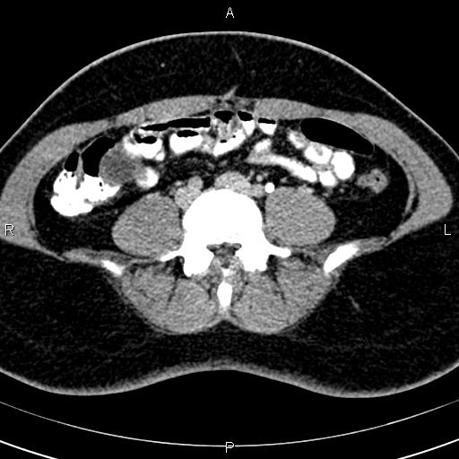 Bilateral ovarian teratoma (Radiopaedia 83131-97503 B 2).jpg