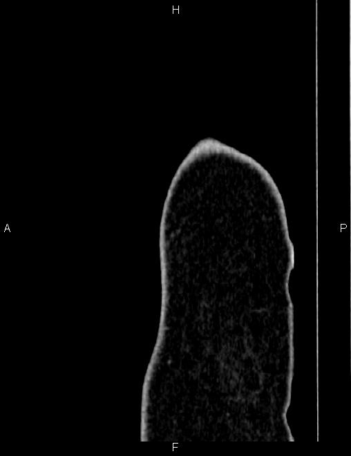Bilateral ovarian teratoma (Radiopaedia 83131-97503 D 119).jpg