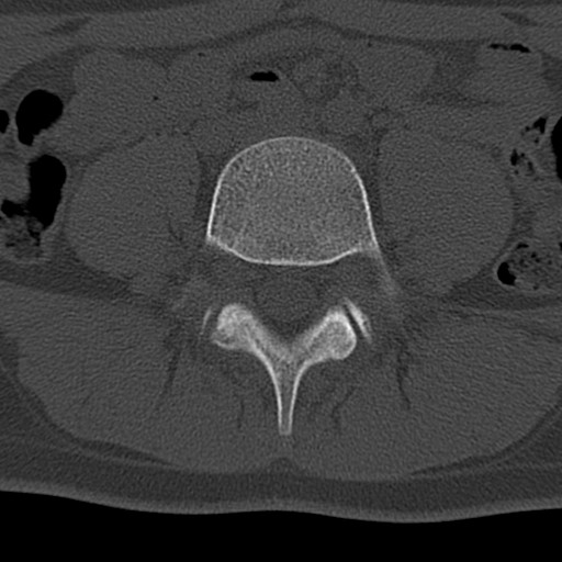 Bilateral pars defect (Radiopaedia 26691-26846 Axial bone window 34).jpg