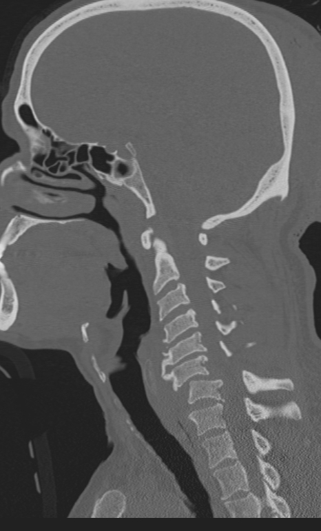 Bilateral perched facet joint (Radiopaedia 63149-71669 Sagittal bone window 35).jpg