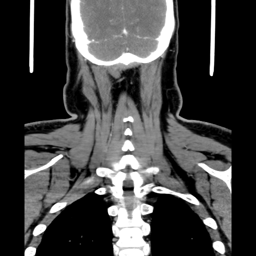 File:Bilateral peritonsillar abscess (Radiopaedia 85065-100610 Coronal 61).jpg