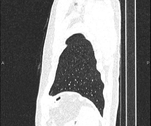 File:Bilateral pulmonary AVM (Radiopaedia 83134-97505 Sagittal lung window 100).jpg