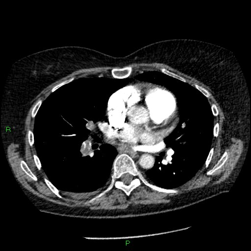 Bilateral pulmonary emboli (Radiopaedia 32700-33669 Axial C+ CTPA 57).jpg