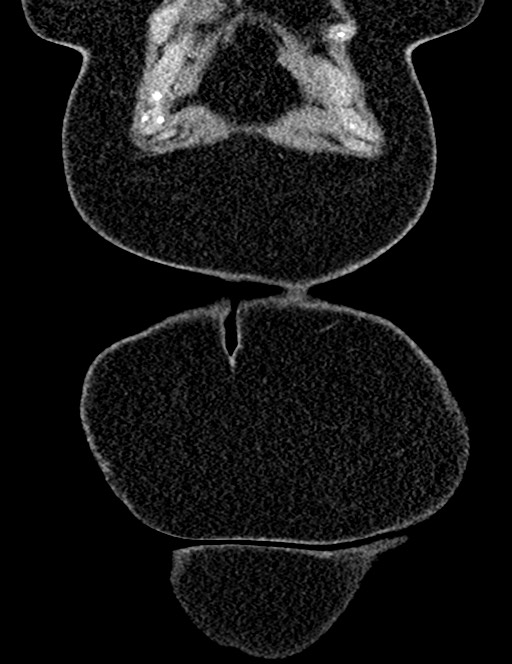 Bilateral staghorn calculi (Radiopaedia 59475-66842 Coronal non-contrast 30).jpg