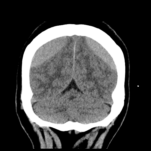 Bilateral subacute subdural hematoma (Radiopaedia 69240-79018 Coronal non-contrast 47).jpg
