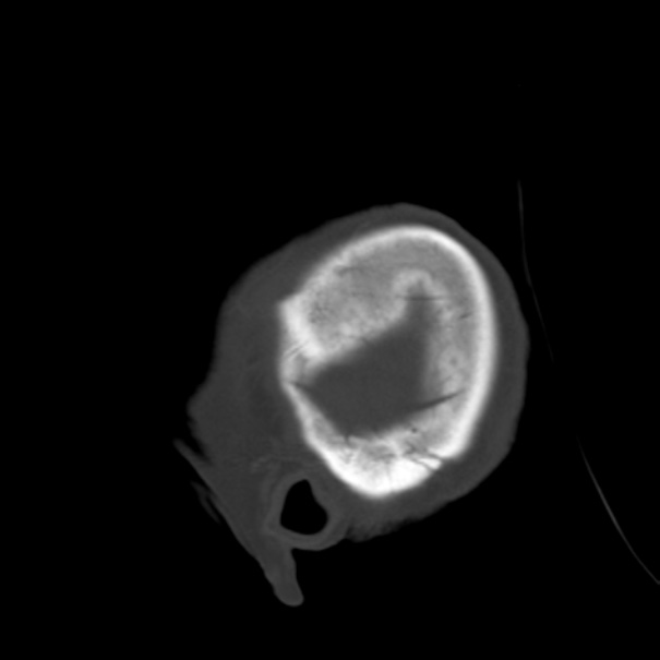 Biparietal osteodystrophy (Radiopaedia 46109-50463 Sagittal bone window 9).jpg